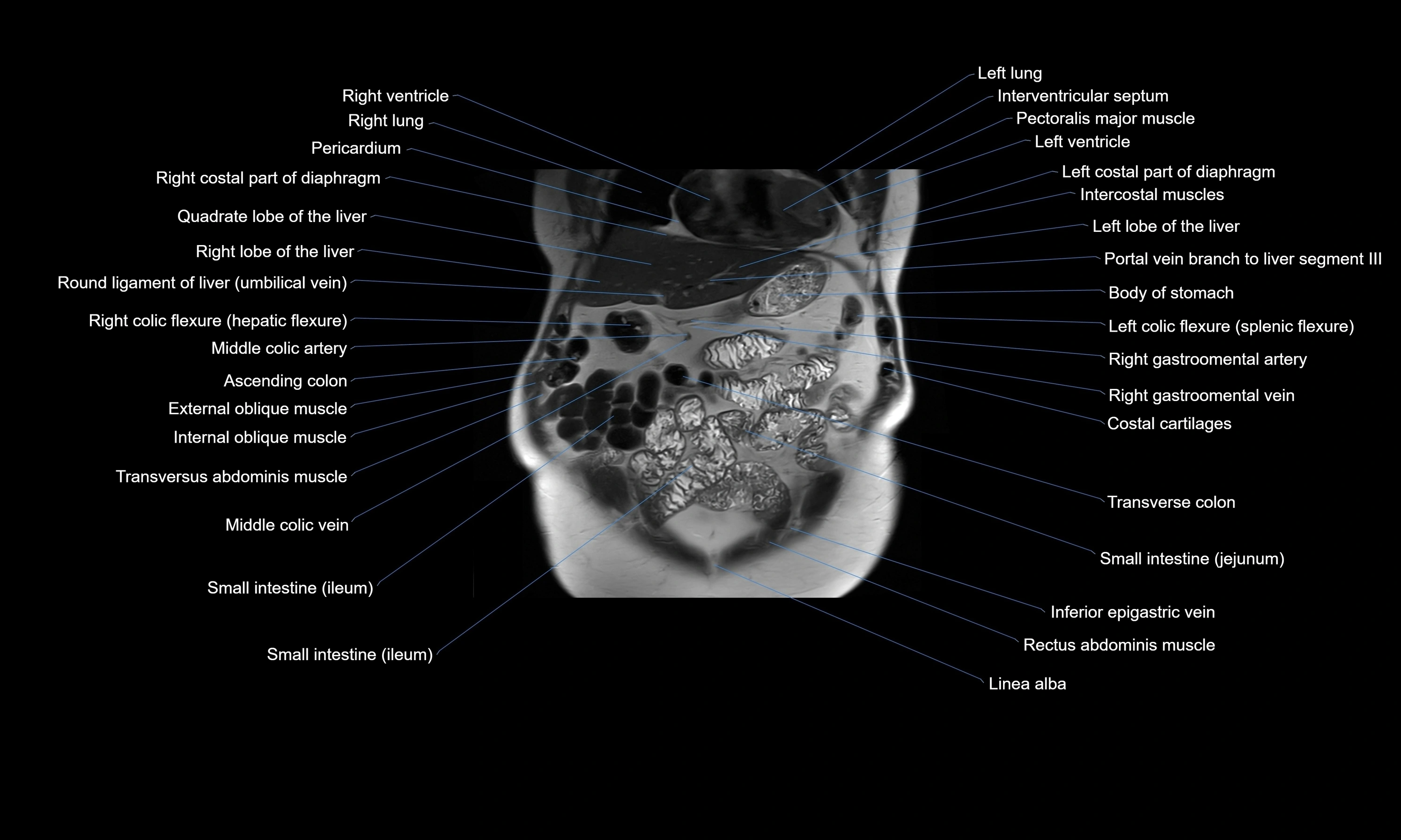 MRI Abdomen axial cross sectional anatomy radiology  image-img-00001-00015.webp